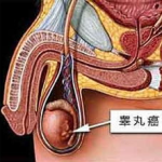 睾丸癌,早期识别与综合治疗策略