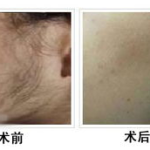 比基尼第一次激光脱毛的效果,效果显著，告别尴尬瞬间”